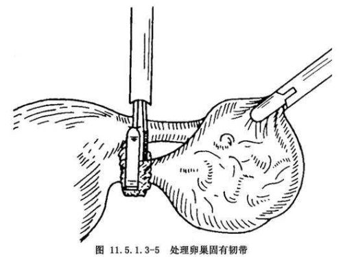 单侧卵巢切除还能做试管婴儿吗?