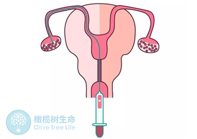 去泰国做试管婴儿会伤害到女性的身体吗？