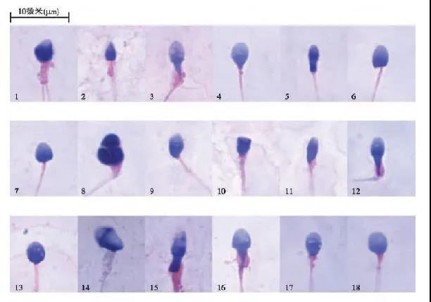 精子报告单看不懂？生殖专家教你解析精液报告！