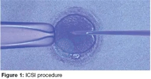 卵胞浆内单精子注射（ICSI）技术