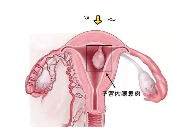 子宫内膜息肉切除后去泰国做试管成功率高吗？