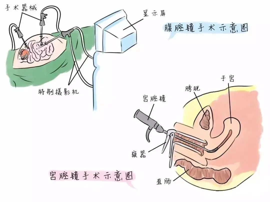 子宫内膜息肉