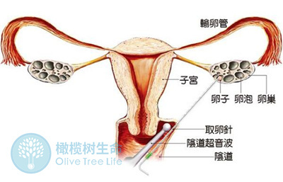 到做试管如果一次取卵数量不够是否要再取一次？