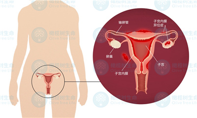 子宫基层受损能做泰国试管婴儿吗？