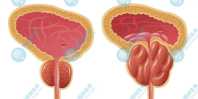 前列腺囊肿会影响生育吗，可以去泰国做试管吗？