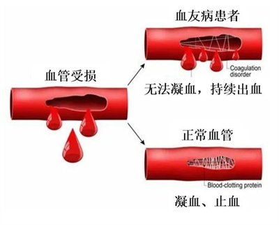 世界血友病日|关爱“玻璃人”，三代试管婴儿技术阻断遗传病！