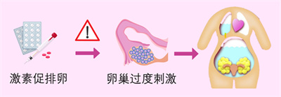 如何规避试管助孕周期中的大敌——卵巢过度刺激综合征？