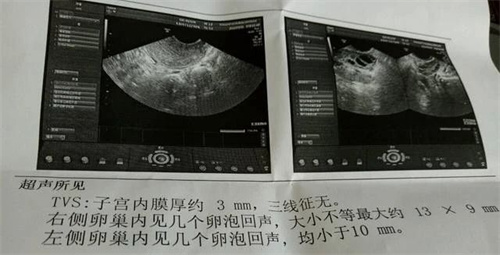 试管人群必看：为什么卵泡数≠取卵数≠胚胎数？