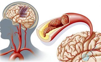 抗心磷脂抗体阳性对试管助孕有什么影响？