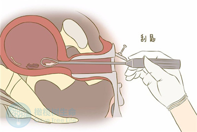 曾经做过刮宫手术，会影响试管婴儿的成功率吗？