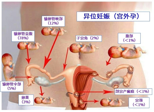 输卵管切除后做试管婴儿，还会发生宫外孕吗？