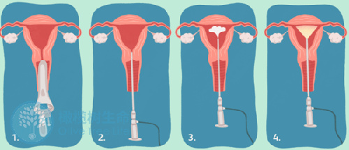 宫腔积液：胚胎移植的隐形“绊脚石”？一文带你了解如何提高成功率！
