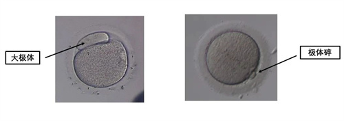 卵母细胞形态学异常对试管婴儿有什么影响？
