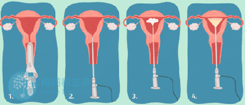 关于试管婴儿中宫腔镜检查的科普！你想知道的都在这里
