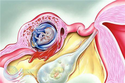 宫外孕还能转回宫内？劝你别太离谱！