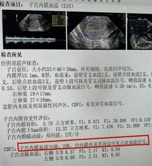 做试管婴儿总失败，建议查一下子宫动脉血流！