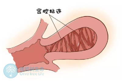 姐妹们如果你的怀孕之路不畅，可能是宫腔粘连所挡的道！