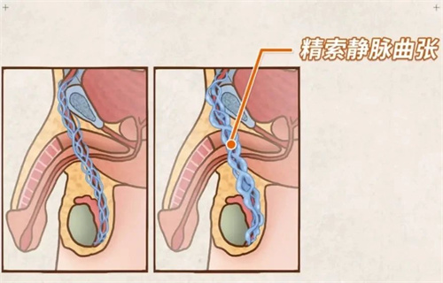 这些容易导致男性不育的因素，80%的人中招！