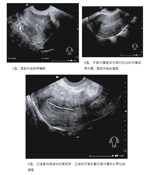 做试管婴儿在胚胎移植前，不妨先了解子宫内膜容受性！