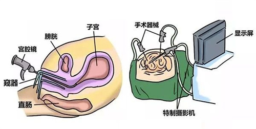 做试管婴儿在胚胎移植前，不妨先了解子宫内膜容受性！