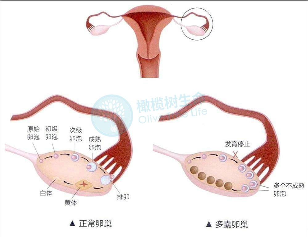 多囊卵巢综合征试管婴儿成功率75%