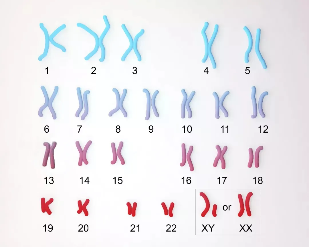 21染色体异常婴儿照片图片